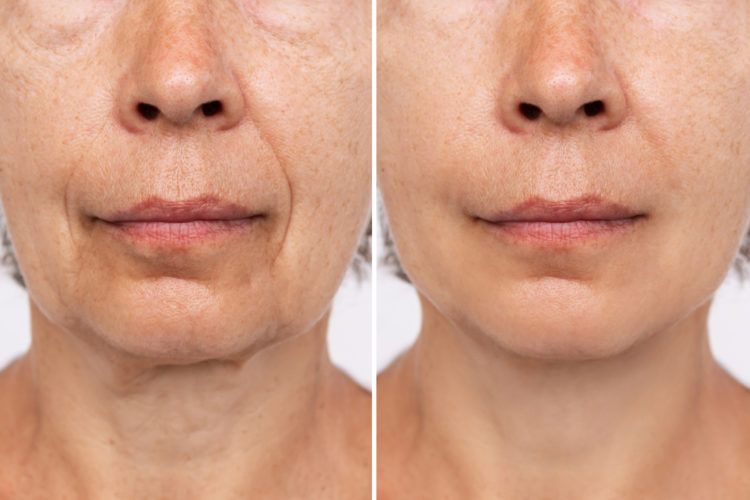 Lower part of face and neck of an elderly woman with signs of sk